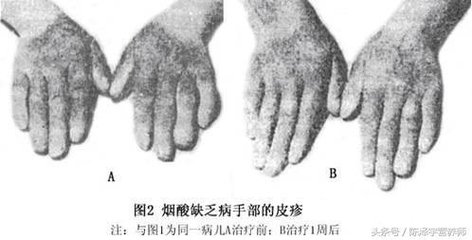 维生素pp缺乏症